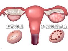 多囊卵巢怎么办?多子不多囊