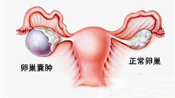 卵巢囊肿的治疗方法是什么？——腹腔镜下微创卵巢囊肿切除术